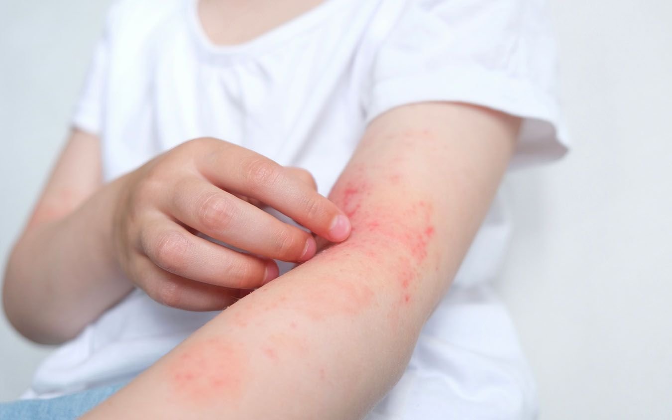 Dermatitis atópica en niña