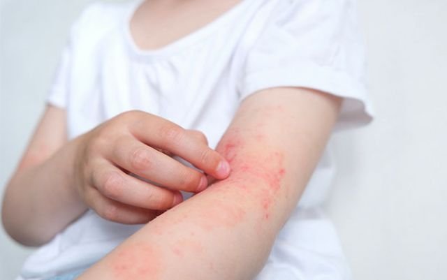 Dermatitis Atópica